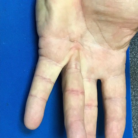 Dupuytren's Contracture