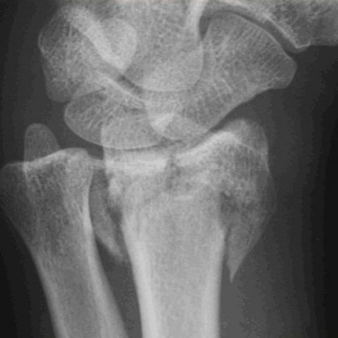Displaced Radius (Wrist) Fracture 