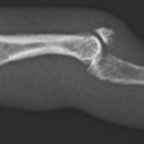 Mallet Fracture