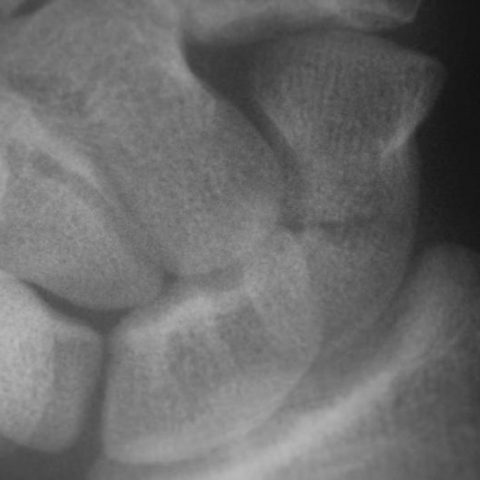 Scaphoid (Carpal Bone) Fracture